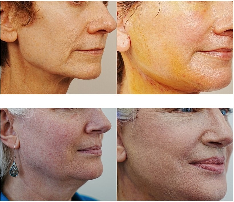 Before and after skin treatment comparison photos.
